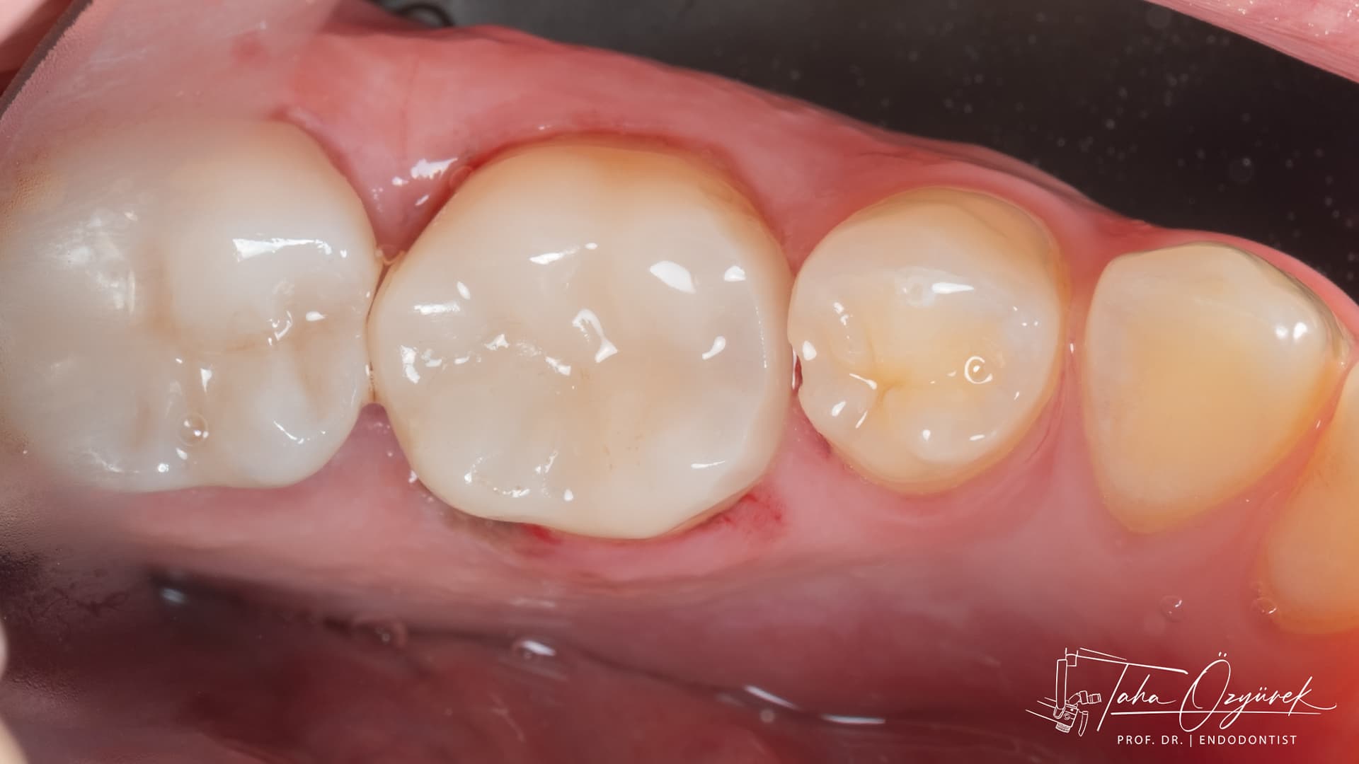 Simante edilmiş overlay restorasyonun oklüzal görünümü